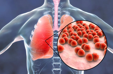Mengenali Gejala Pneumonia untuk Tindakan Cepat dan Tepat
